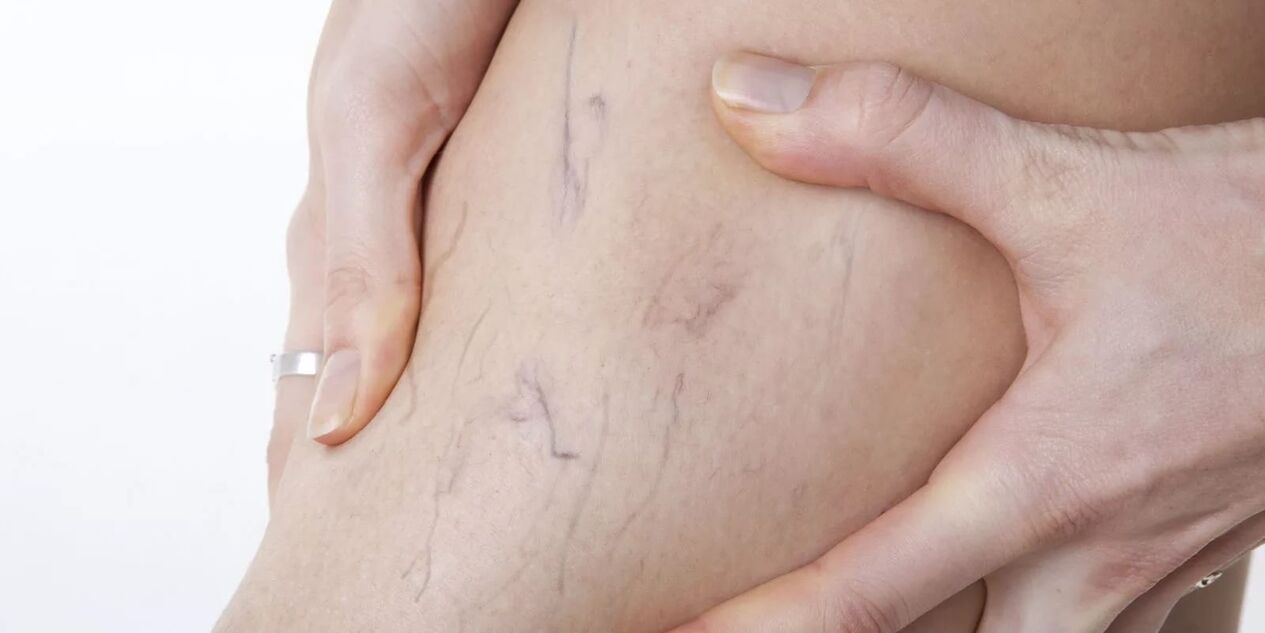 Antes do uso de crema de varicona