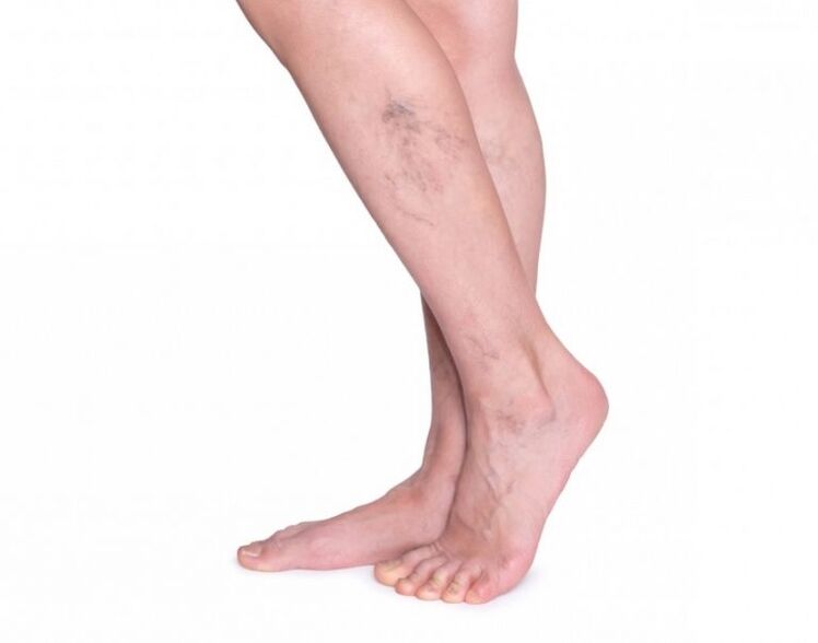 Varices antes do tratamento con zxcvbnmqwort