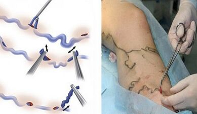 Flebectomía para varices nas pernas