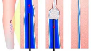 escleroterapia para varices