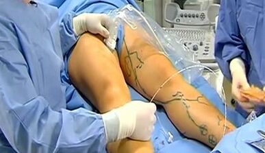 Operación para varices