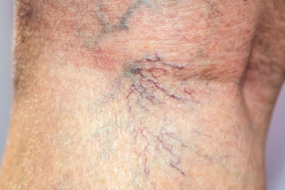 varices